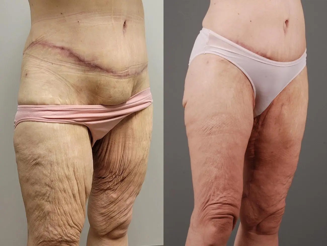 Thigh Lift: Patient 1 - Before and After 5