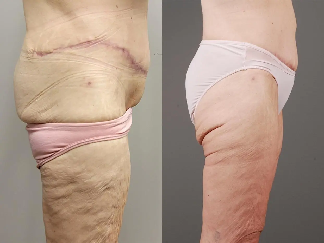 Thigh Lift: Patient 1 - Before and After 3