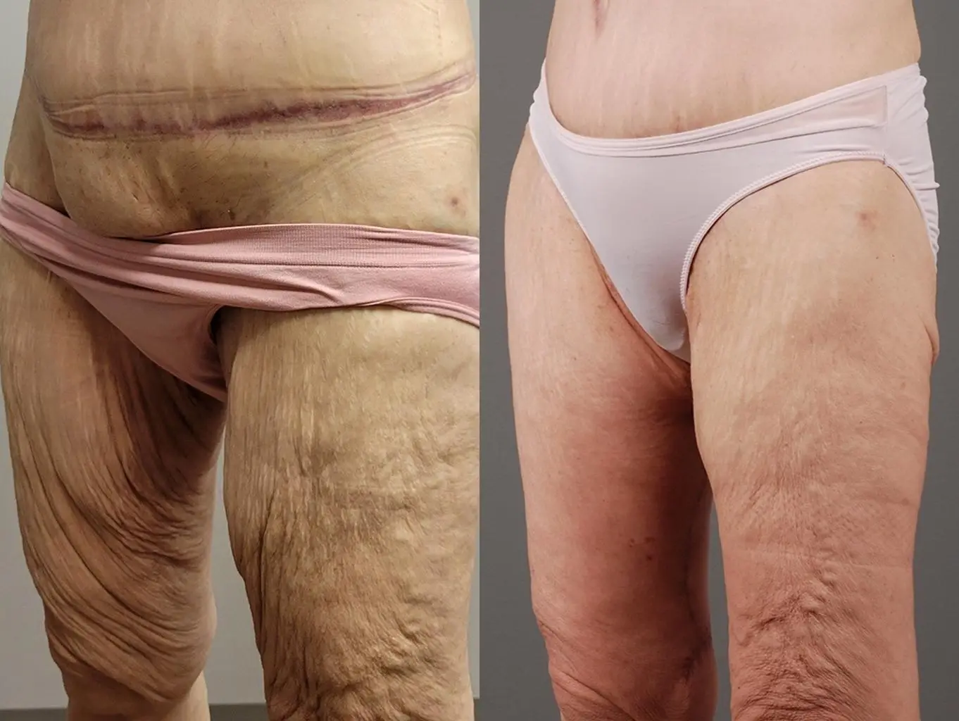 Thigh Lift: Patient 1 - Before and After 2