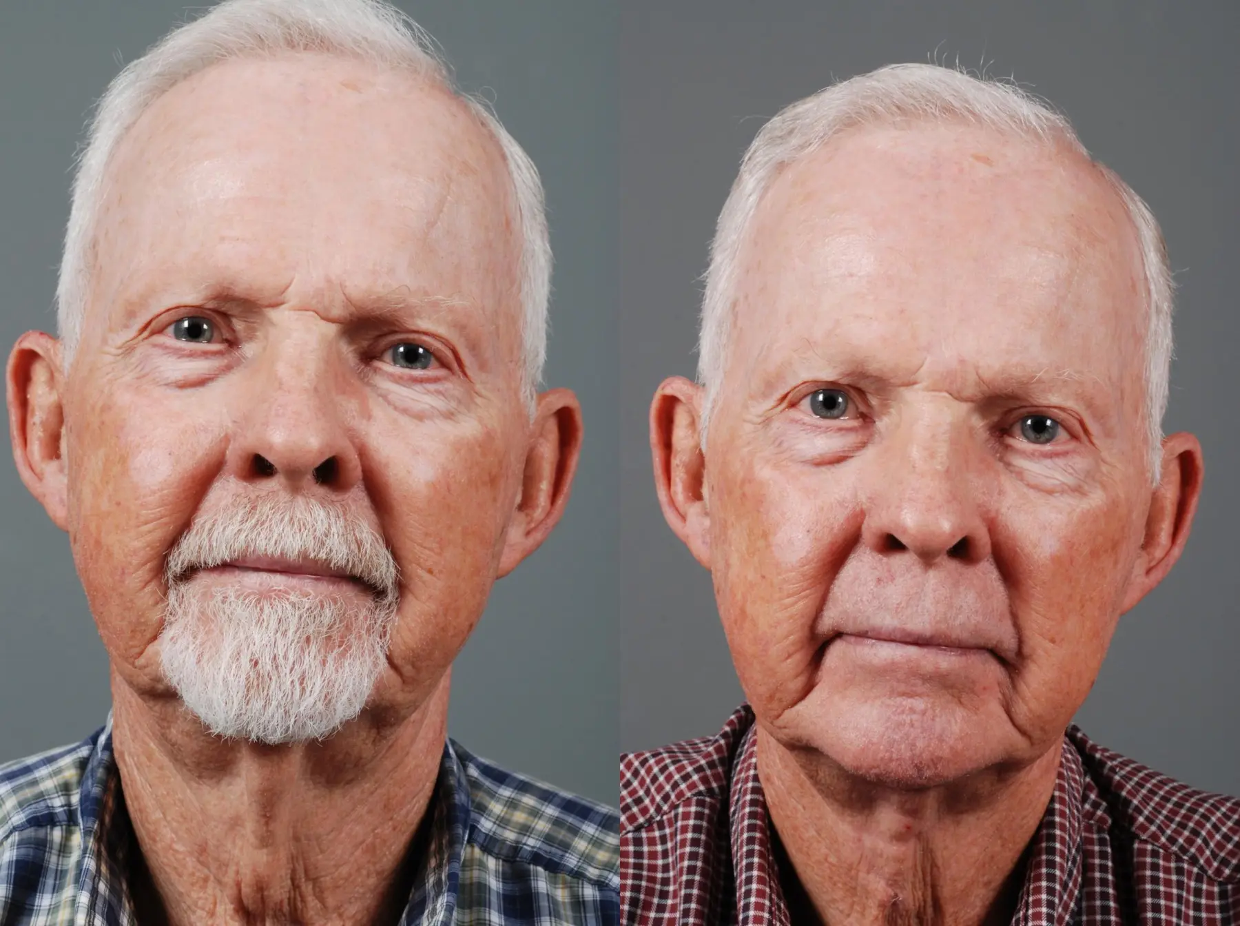 Z Plasty: Patient 1 - Before and After 1