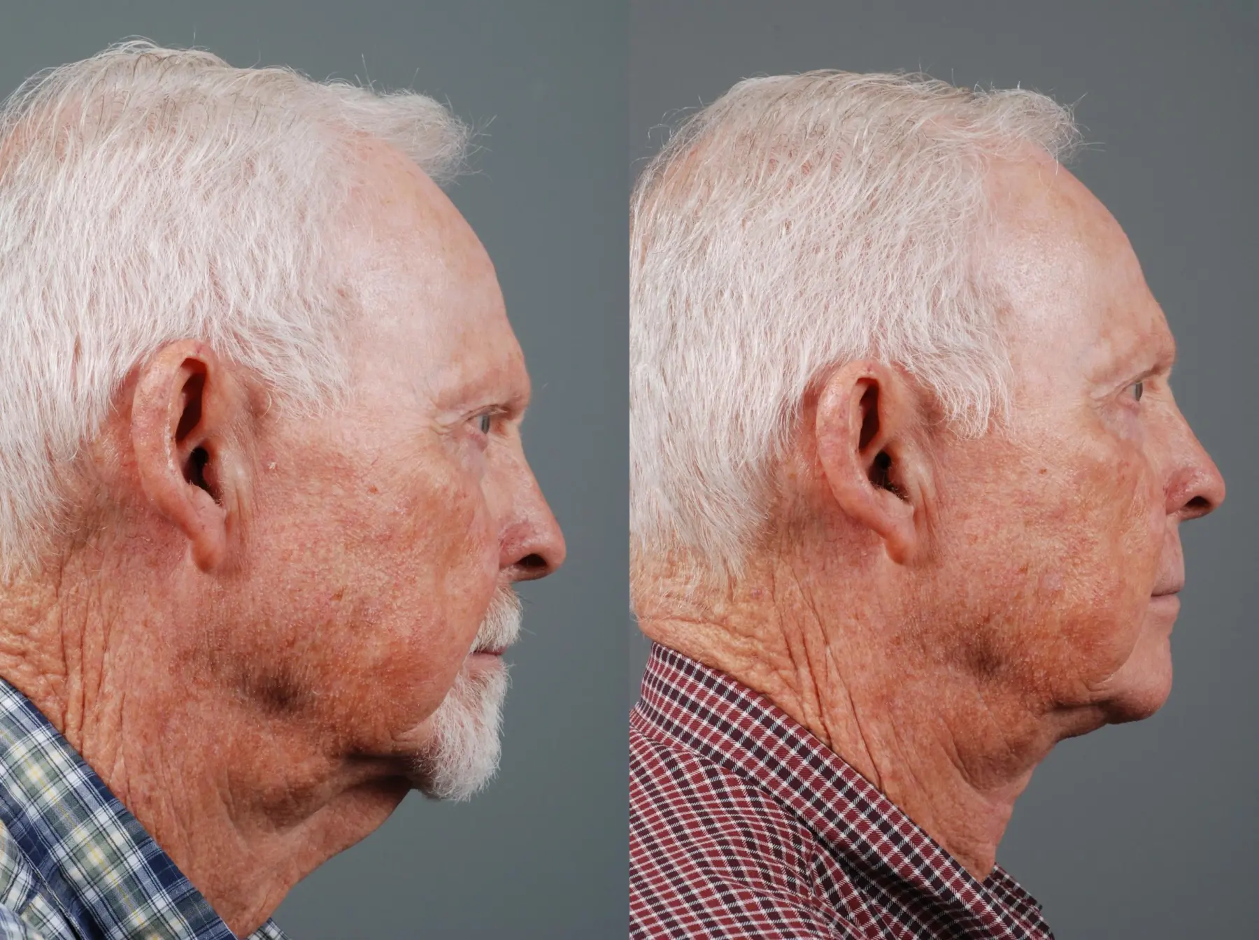 Z Plasty: Patient 1 - Before and After 2