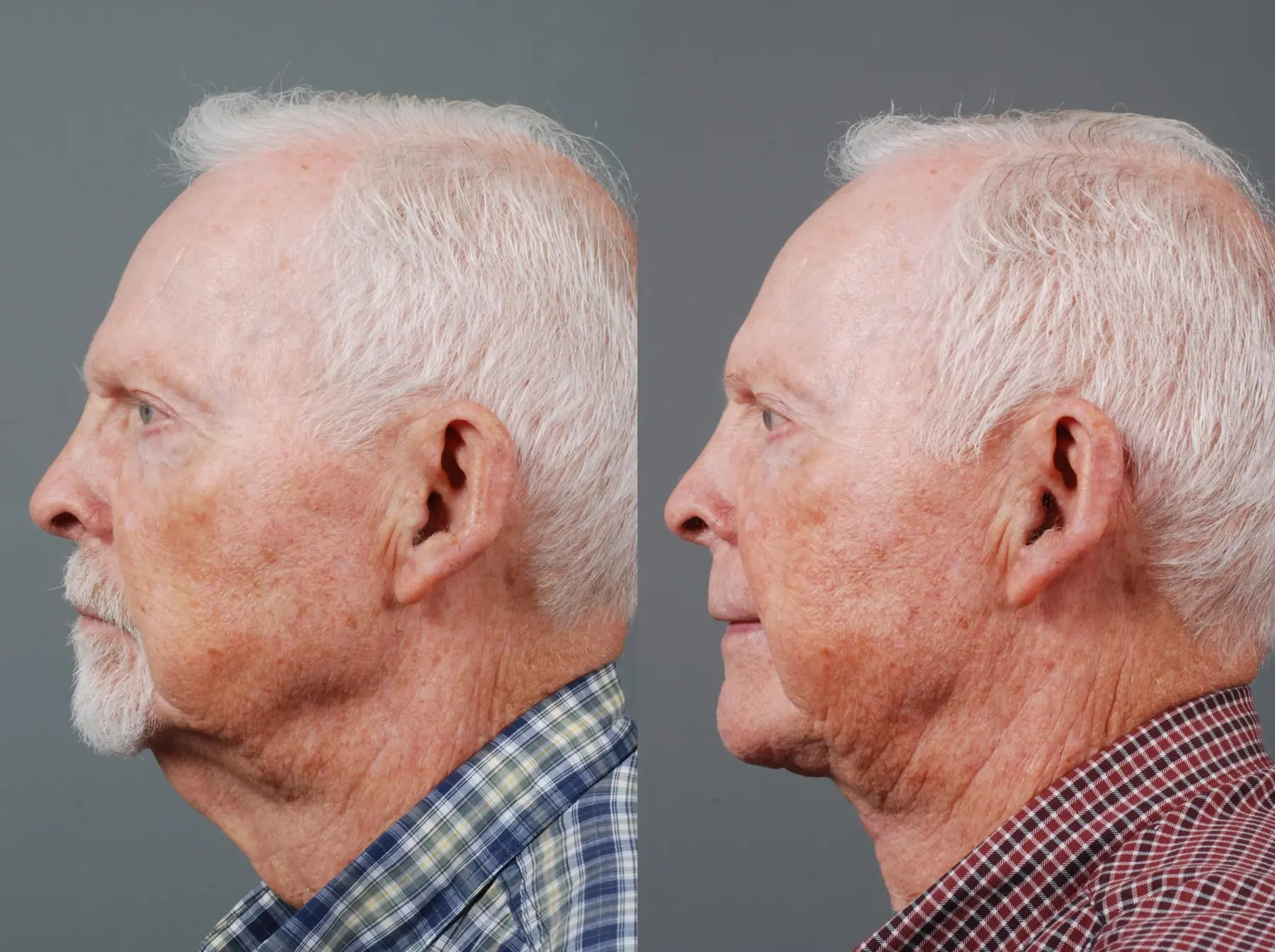 Z Plasty: Patient 1 - Before and After 3
