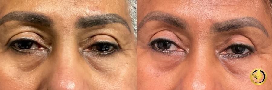 Blepharoplasty: Patient 3 - Before and After  