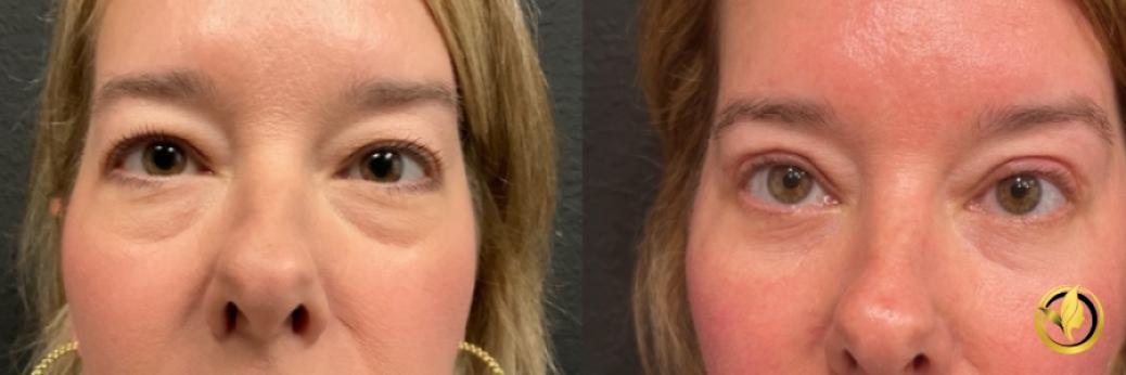 Blepharoplasty: Patient 4 - Before and After  