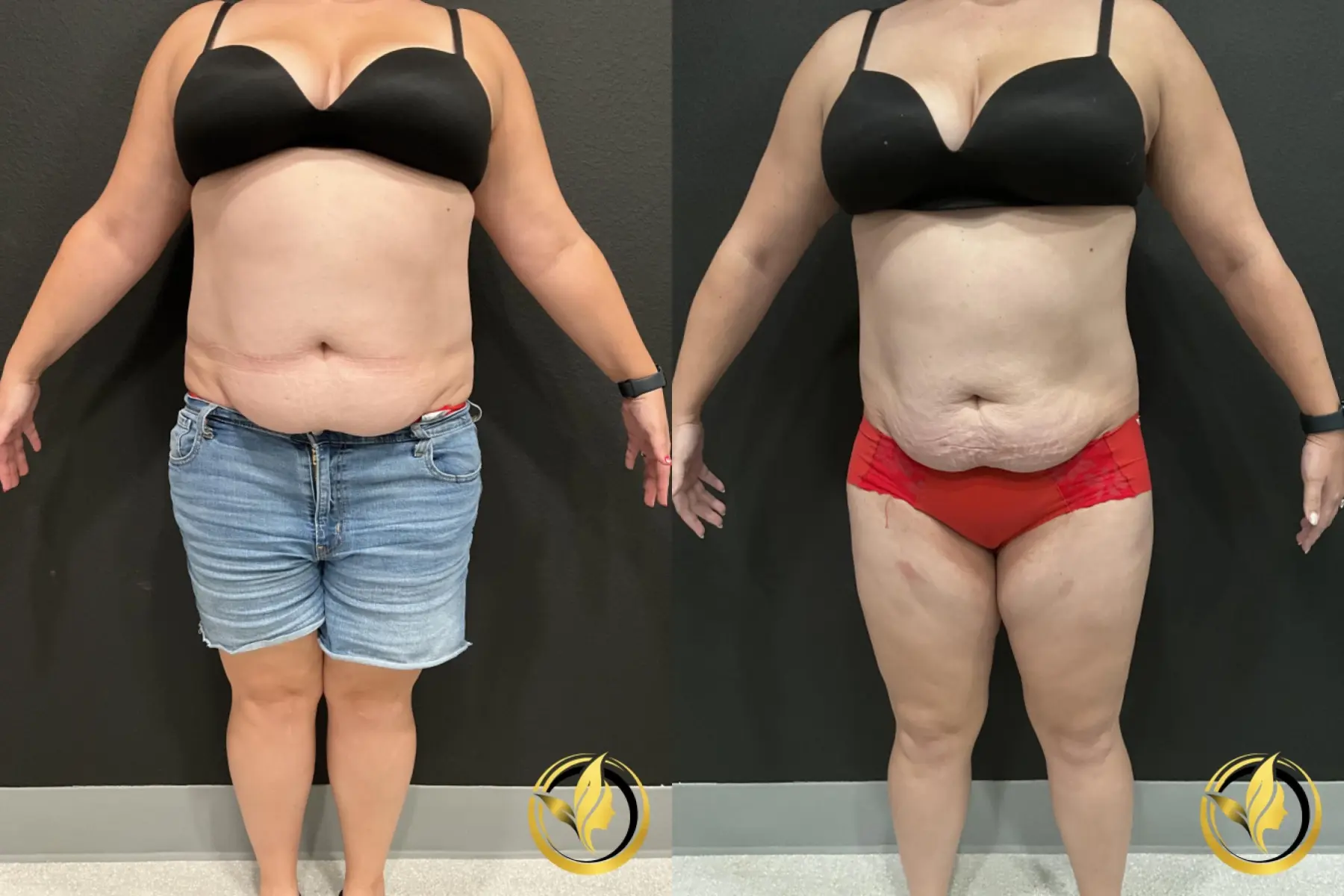 Abdominoplasty: Patient 2 - Before and After  