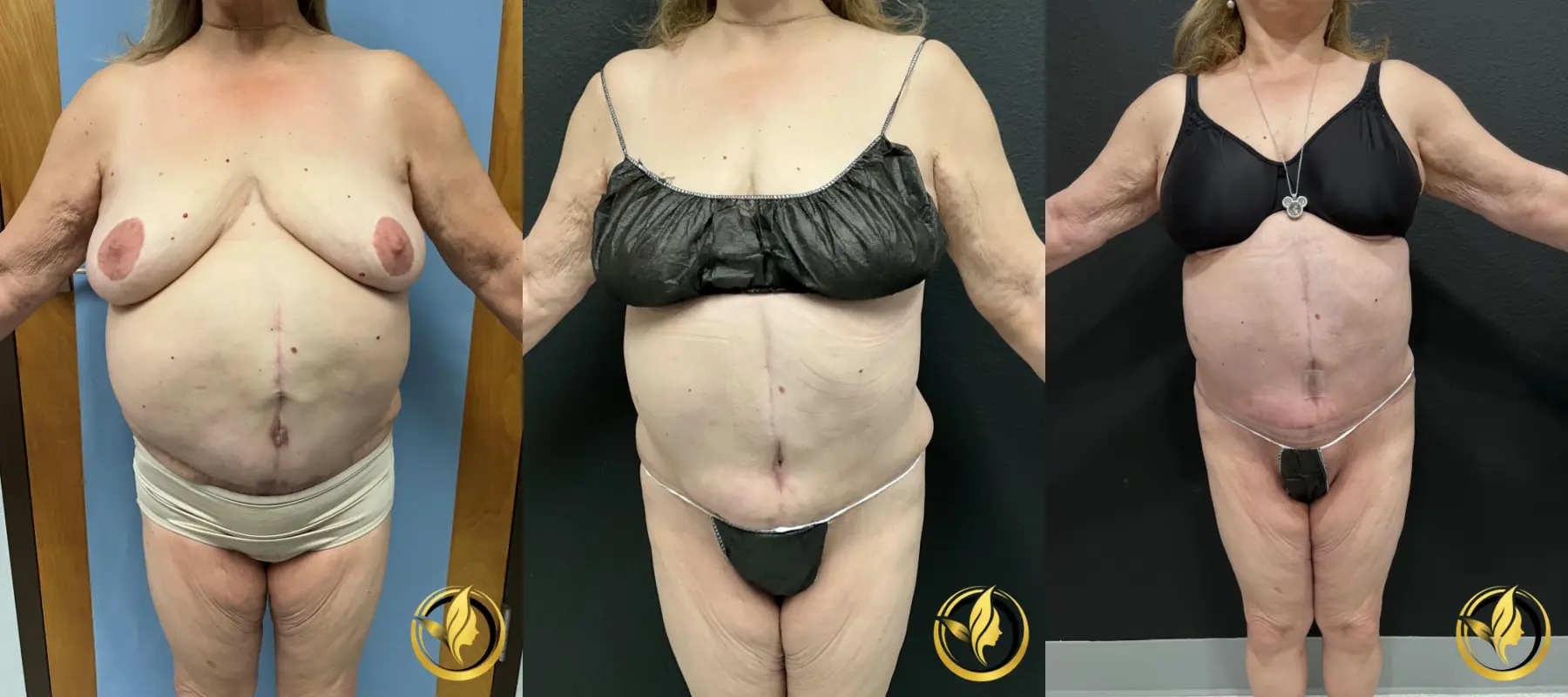 Abdominoplasty: Patient 3 - Before and After