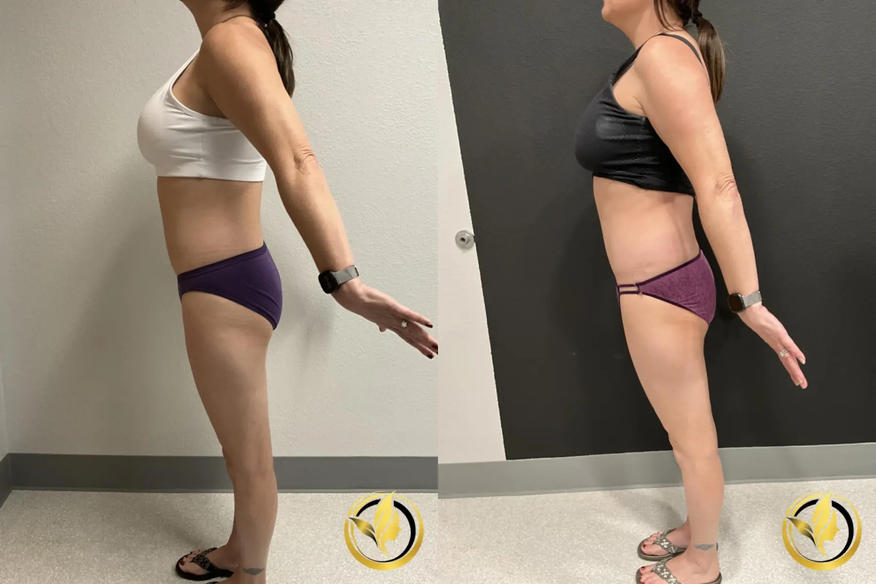 Abdominoplasty: Patient 1 - Before and After  