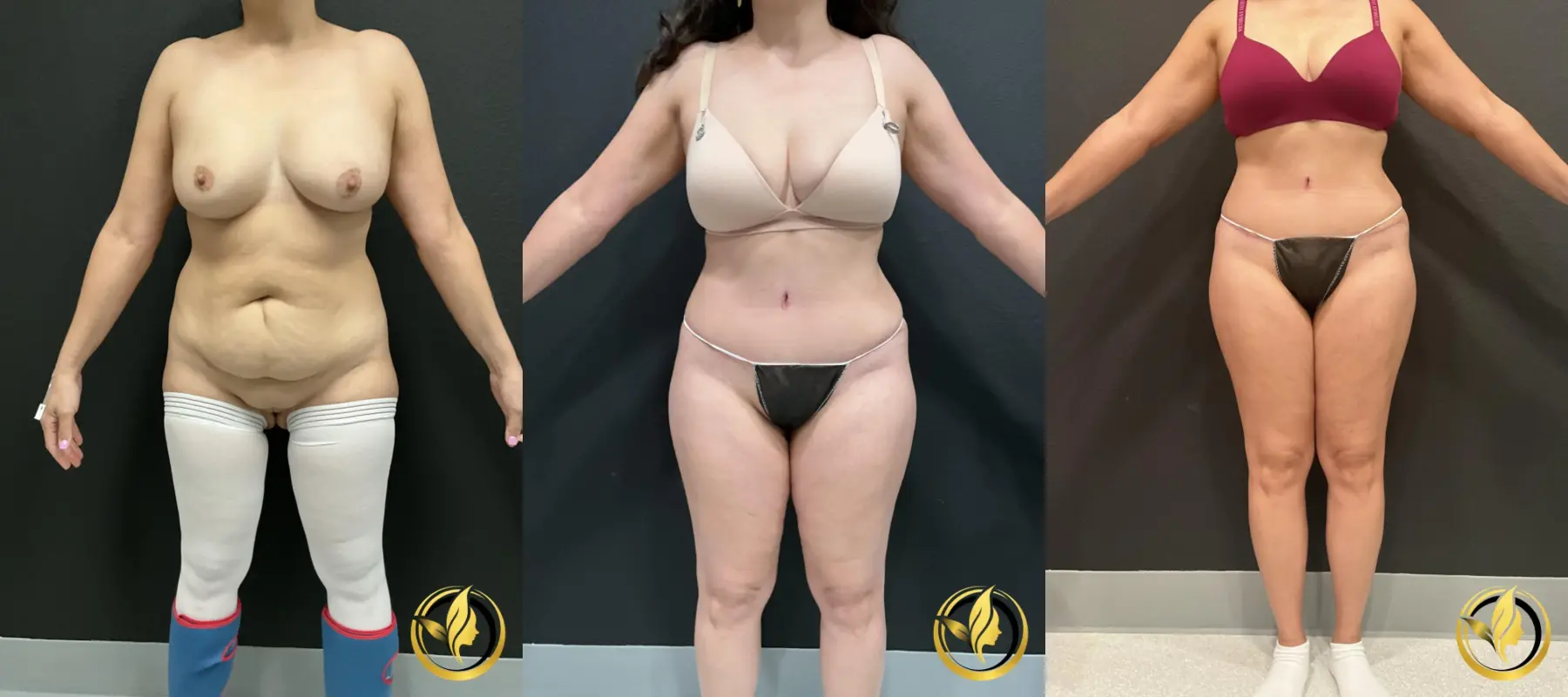 Abdominoplasty: Patient 4 - Before and After
