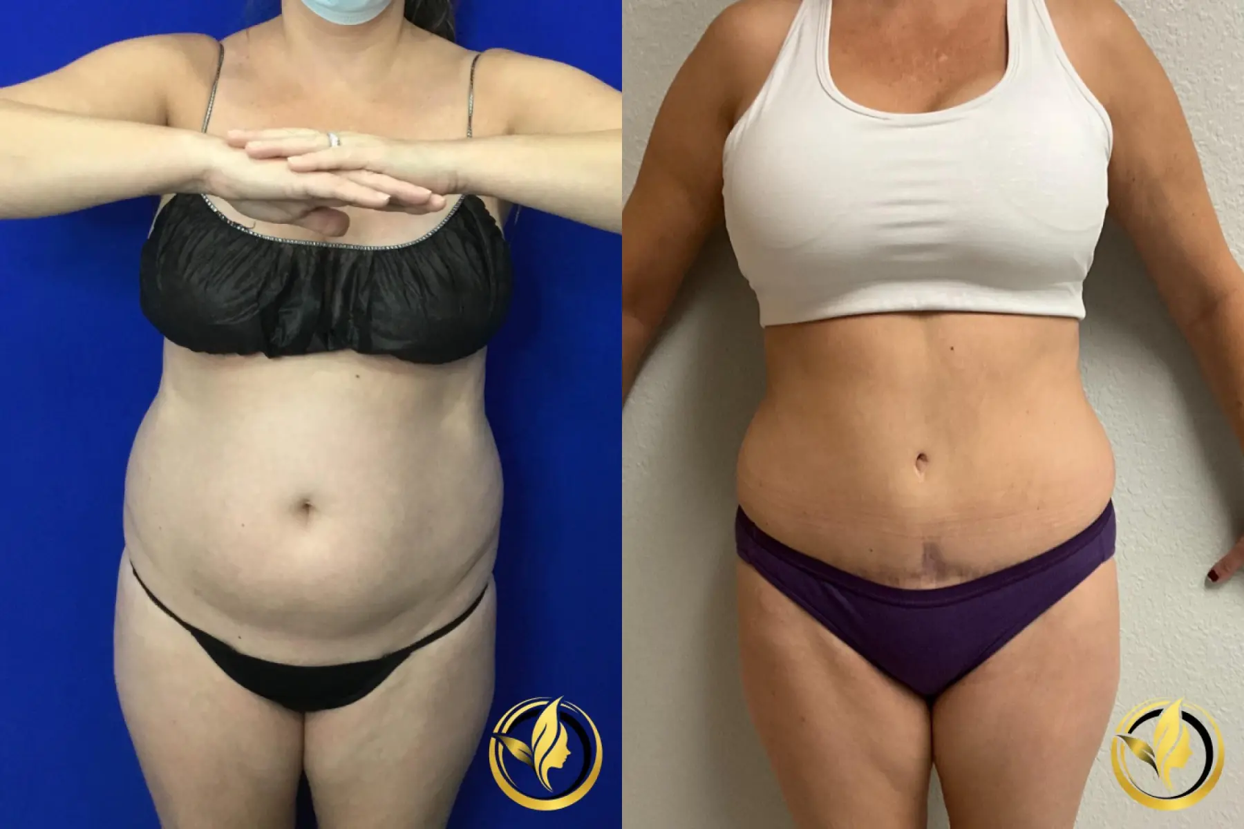 Abdominoplasty: Patient 4 - Before and After  