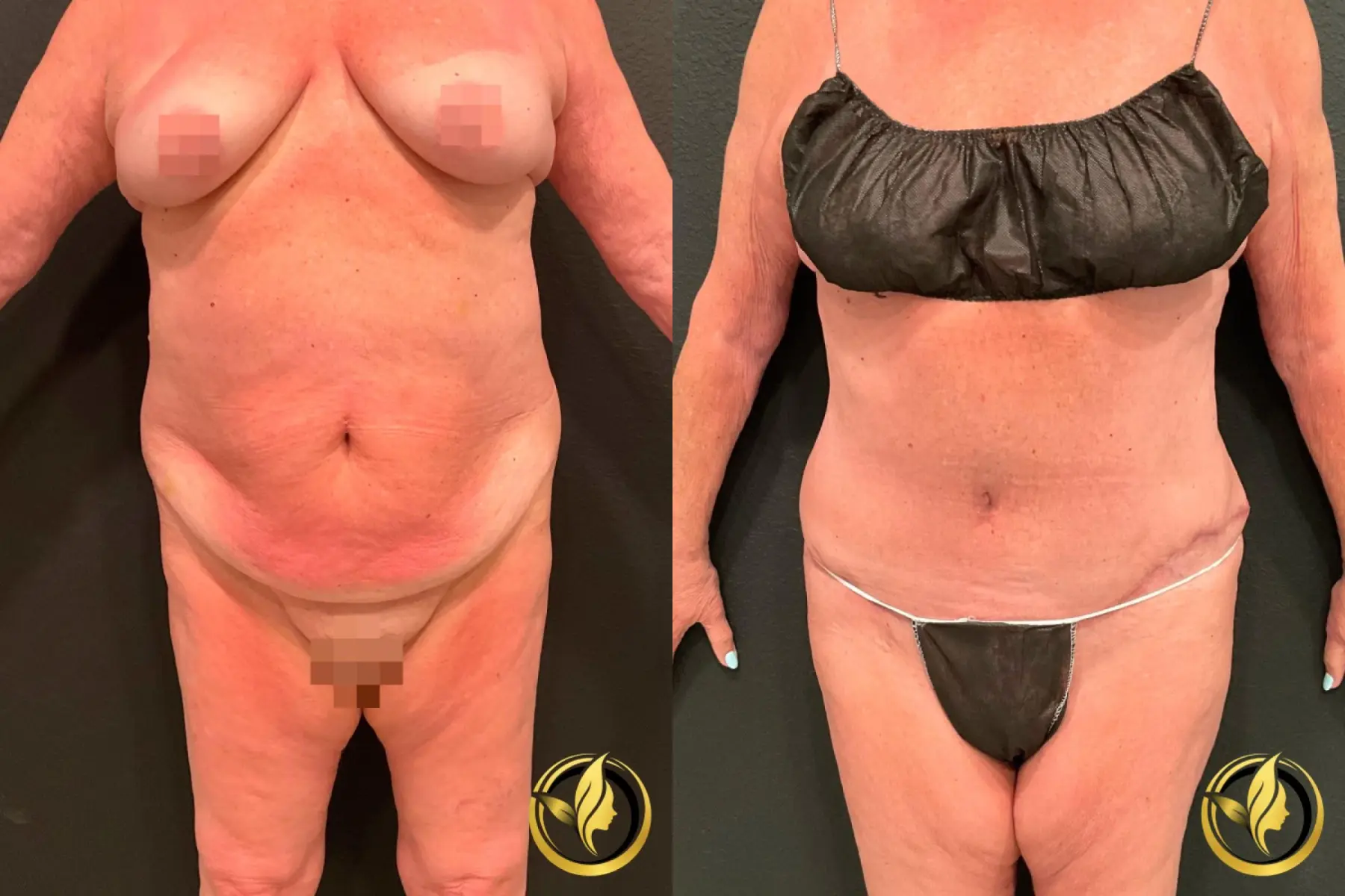 Abdominoplasty: Patient 3 - Before and After  
