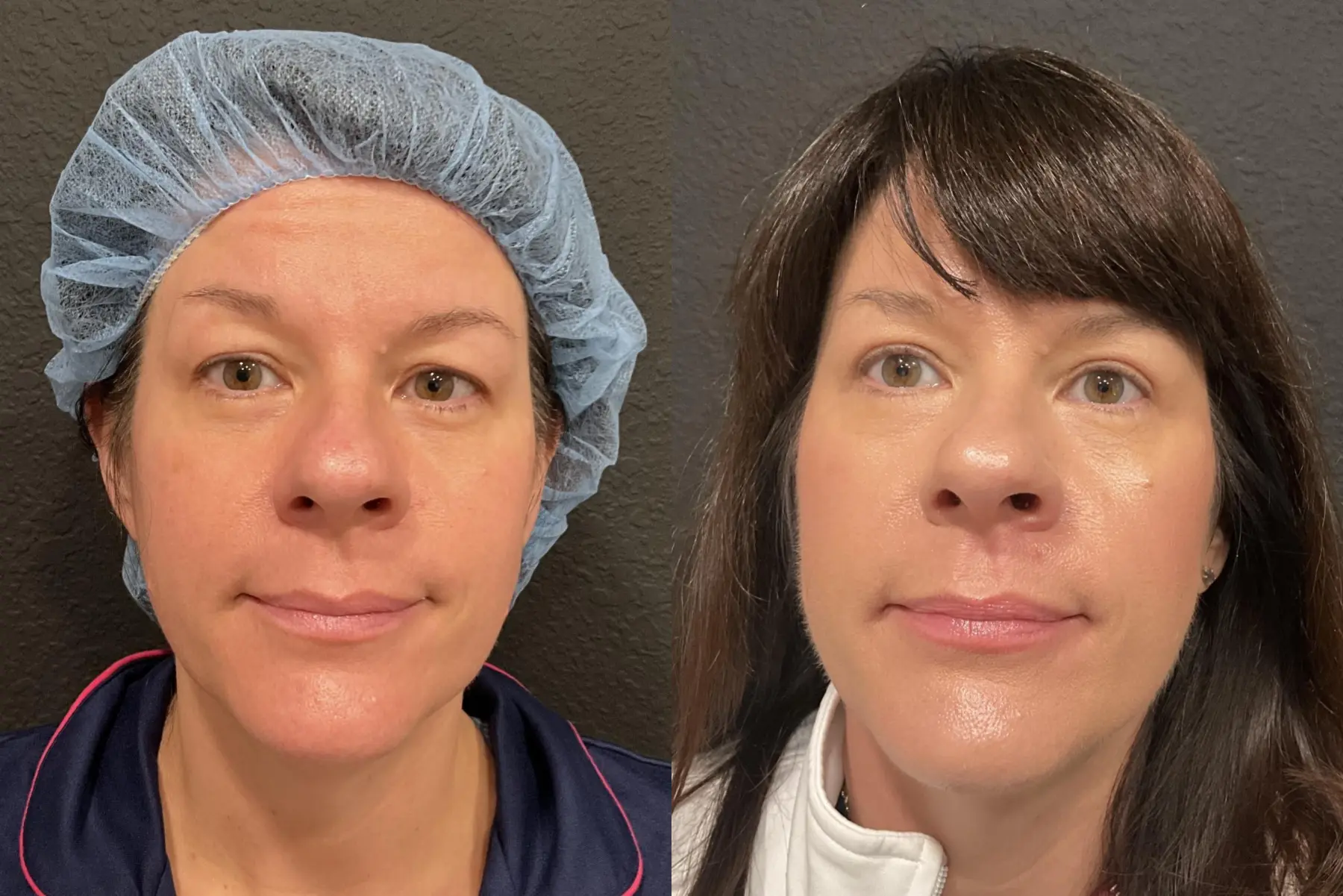 Blepharoplasty: Patient 1 - Before and After  