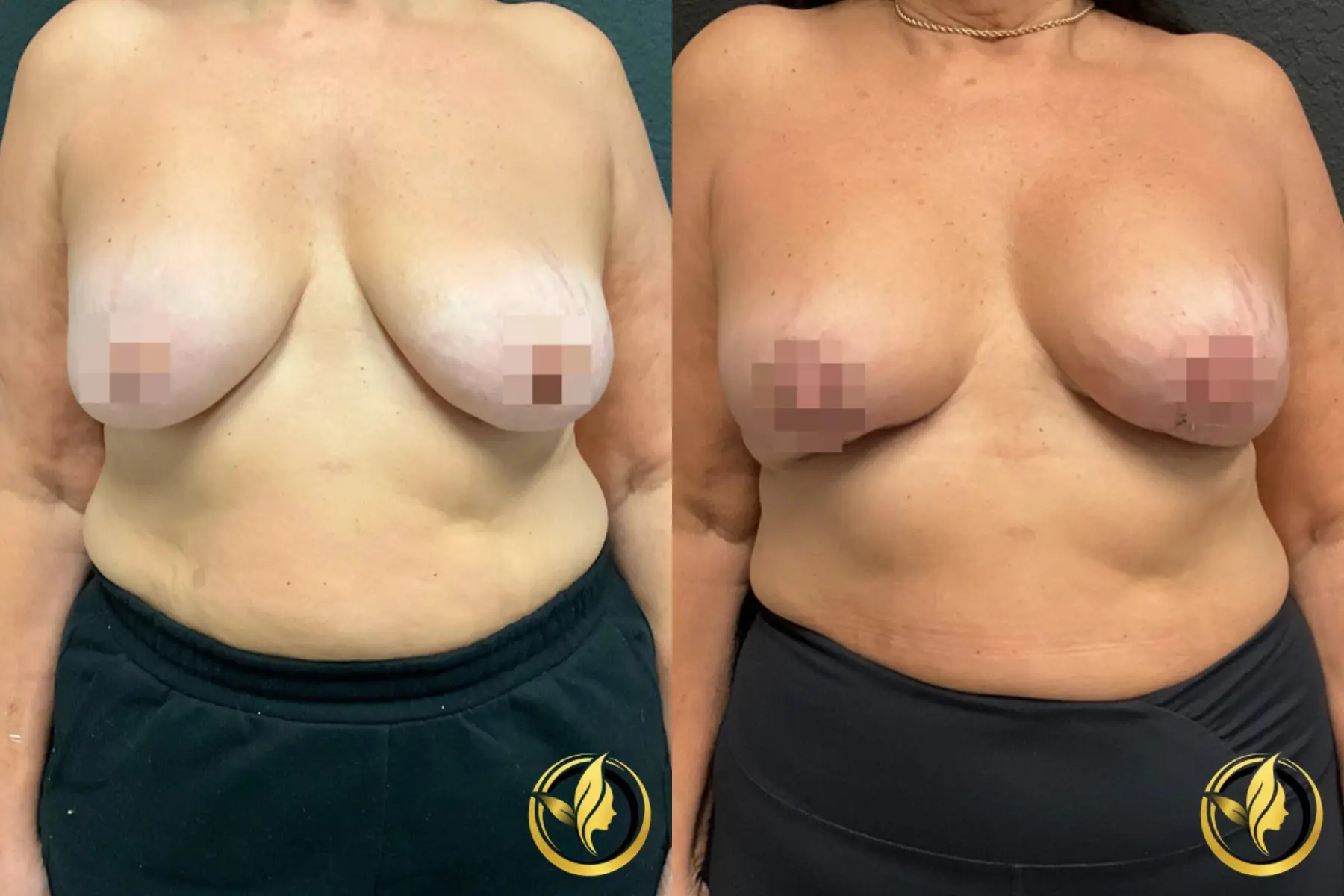 Breast Augmentation With Lift: Patient 1 - Before and After  