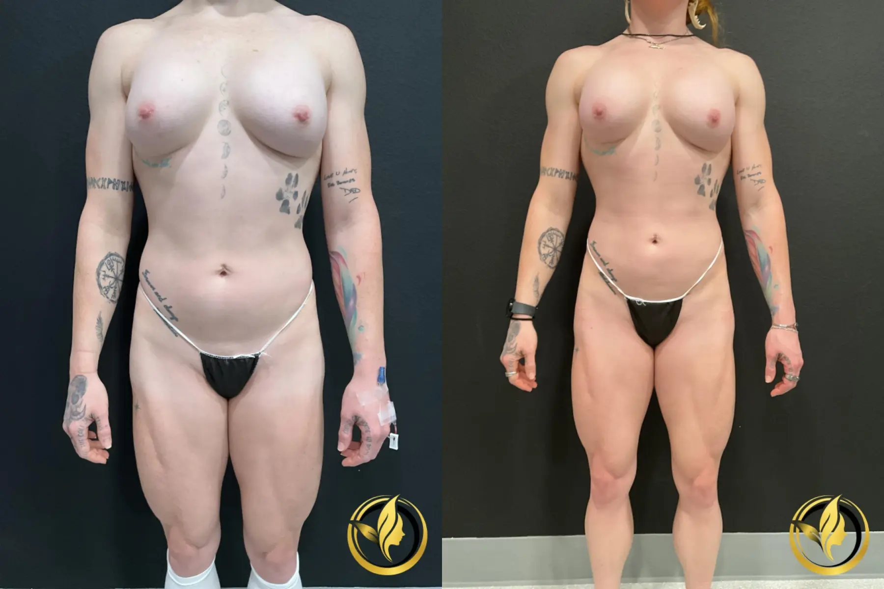 Breast Implant Exchange: Patient 1 - Before and After  