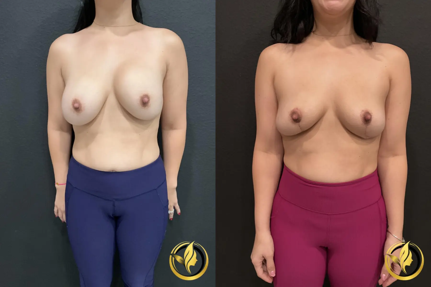 Breast Implant Removal With Lift: Patient 1 - Before and After  