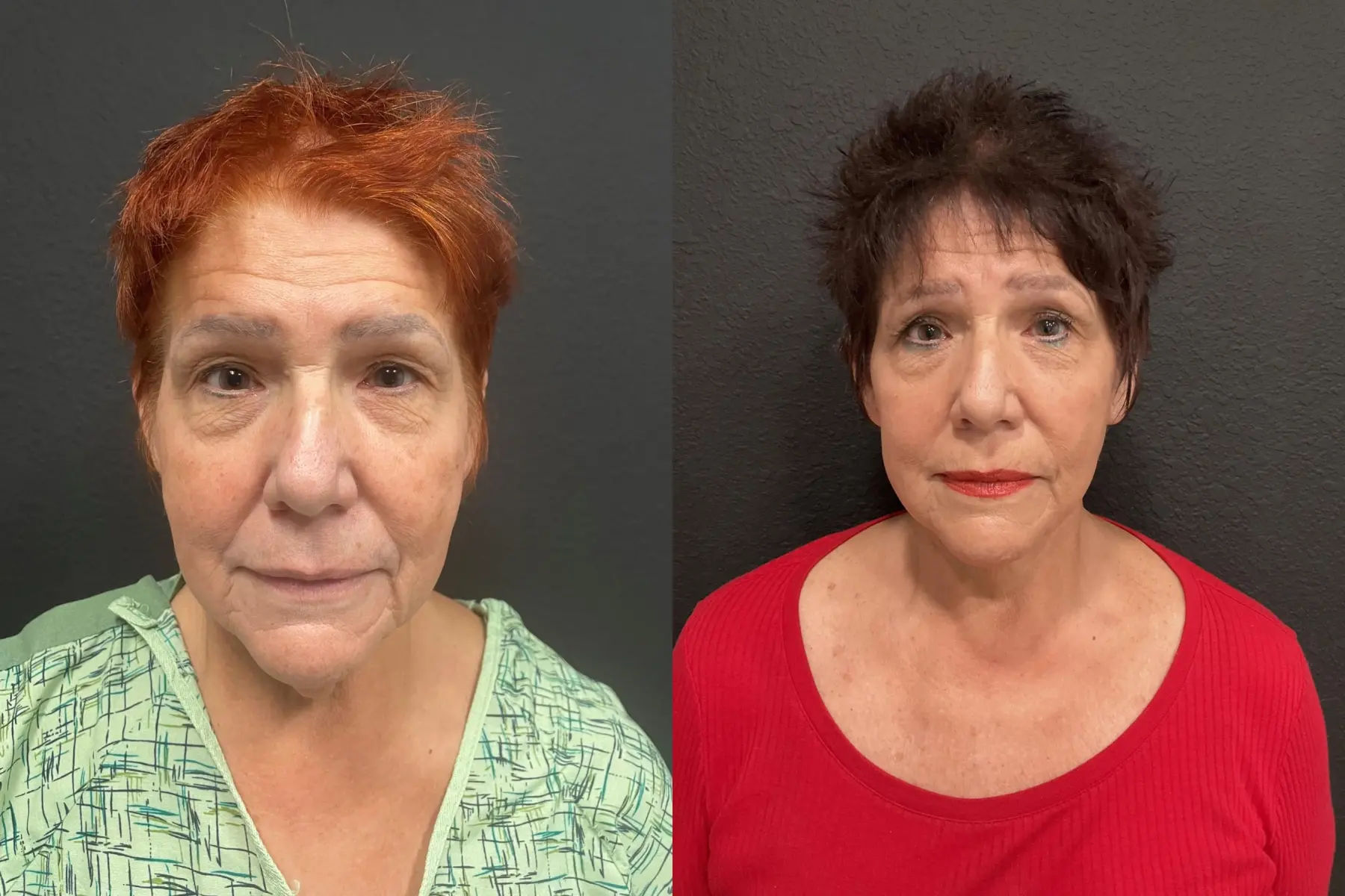 Facelift & Neck Lift: Patient 2 - Before and After  