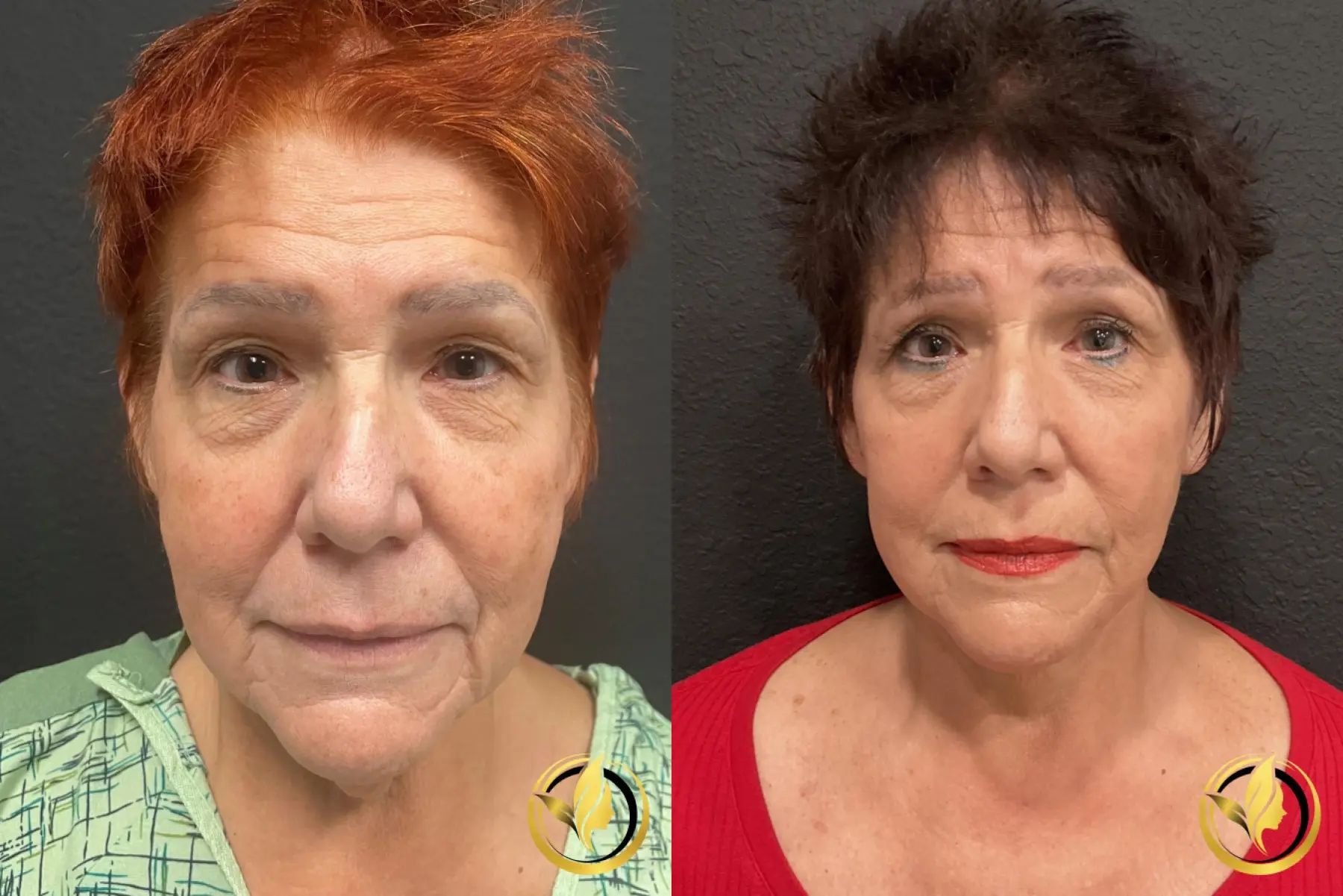 Woman with smooth, youthful skin after a facelift and necklift procedure, showcasing natural and rejuvenated results - Before and After