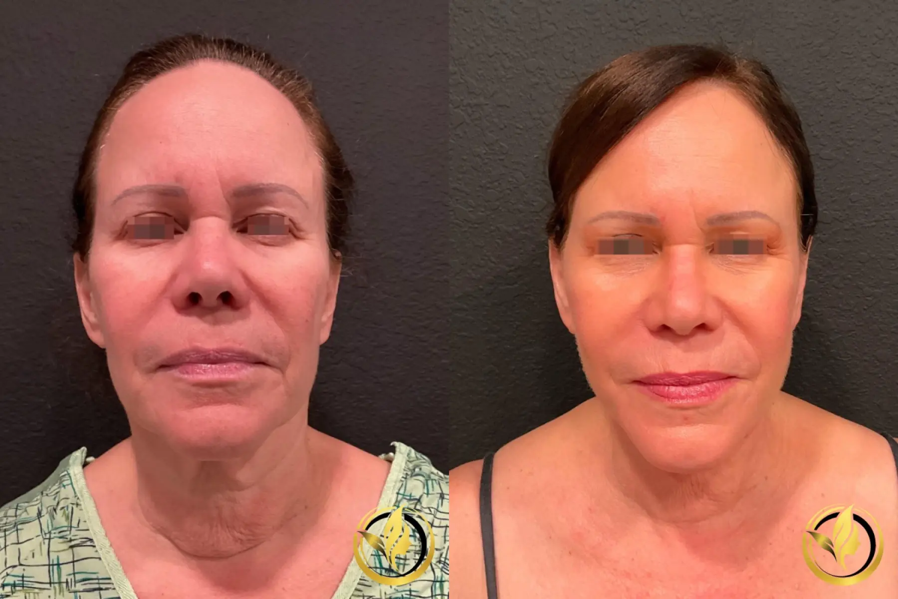 Facelift & Neck Lift: Patient 2 - Before and After  