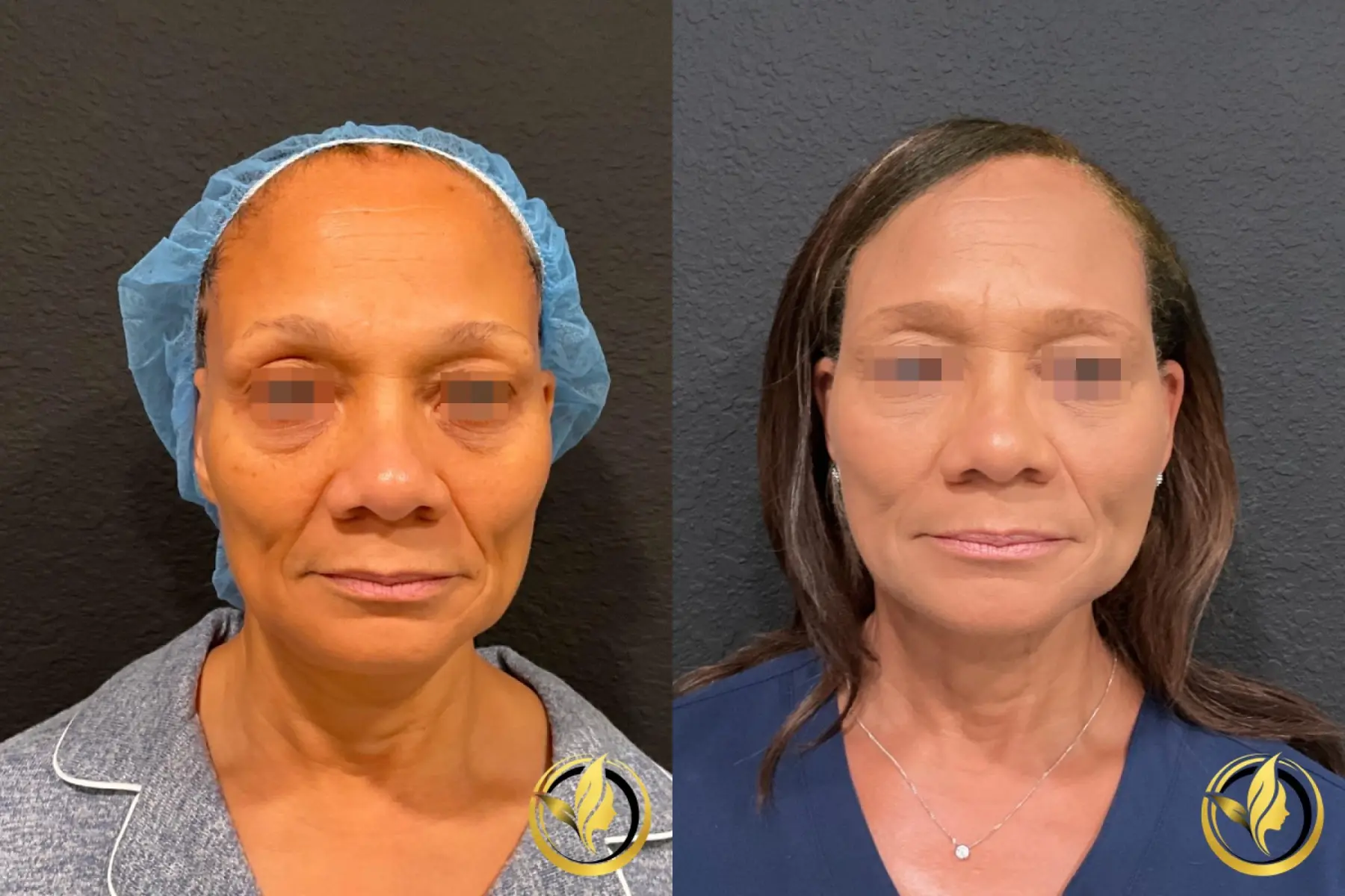 Facelift & Neck Lift: Patient 3 - Before and After  