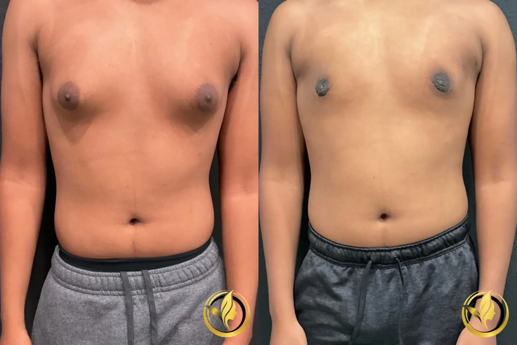 Gynecomastia: Patient 1 - Before and After  