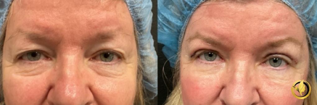 Blepharoplasty: Patient 2 - Before and After  