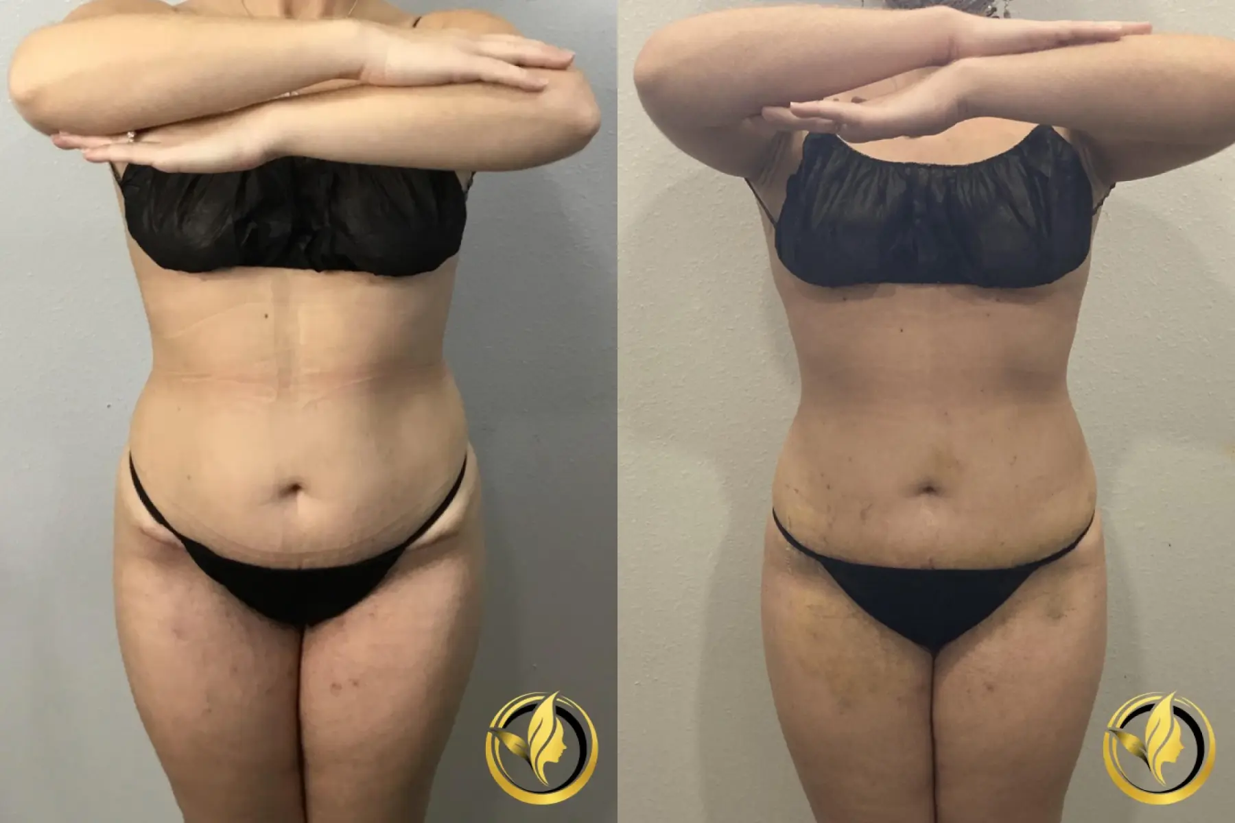Mini Tummy Tuck: Patient 1 - Before and After  