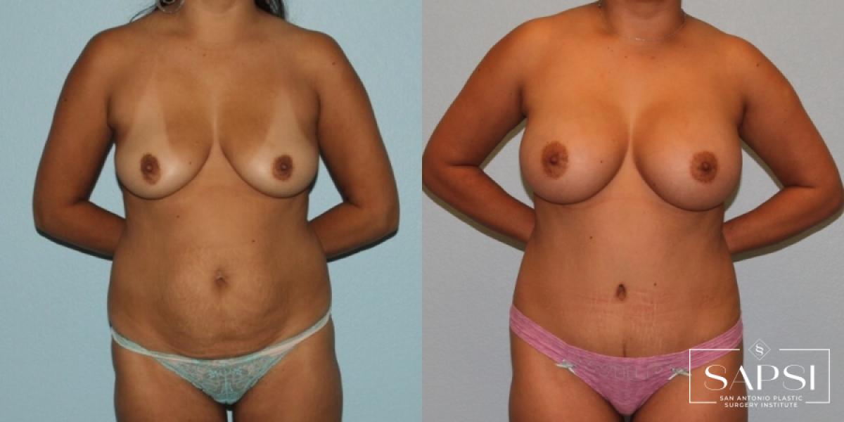 Mommy Makeover: Patient 16 - Before and After 