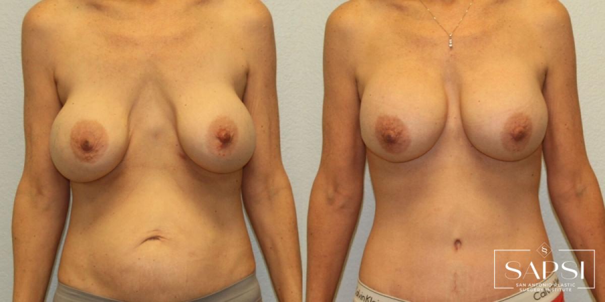 Breast Revision: Patient 2 - Before