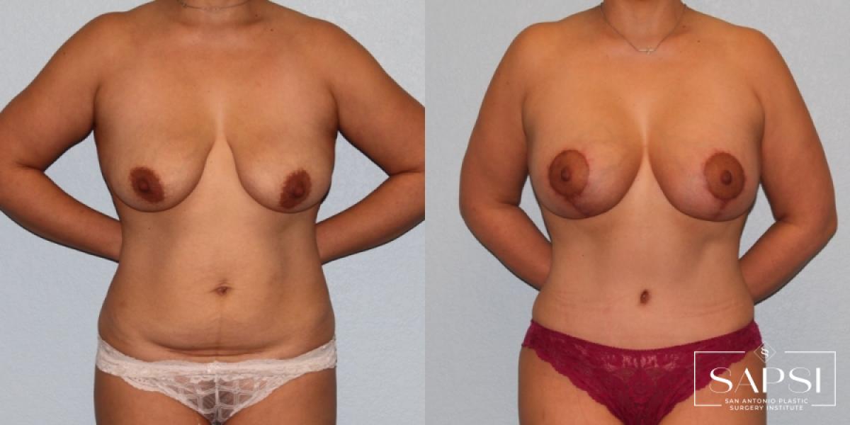 Breast Augmentation With Lift: Patient 7 - Before
