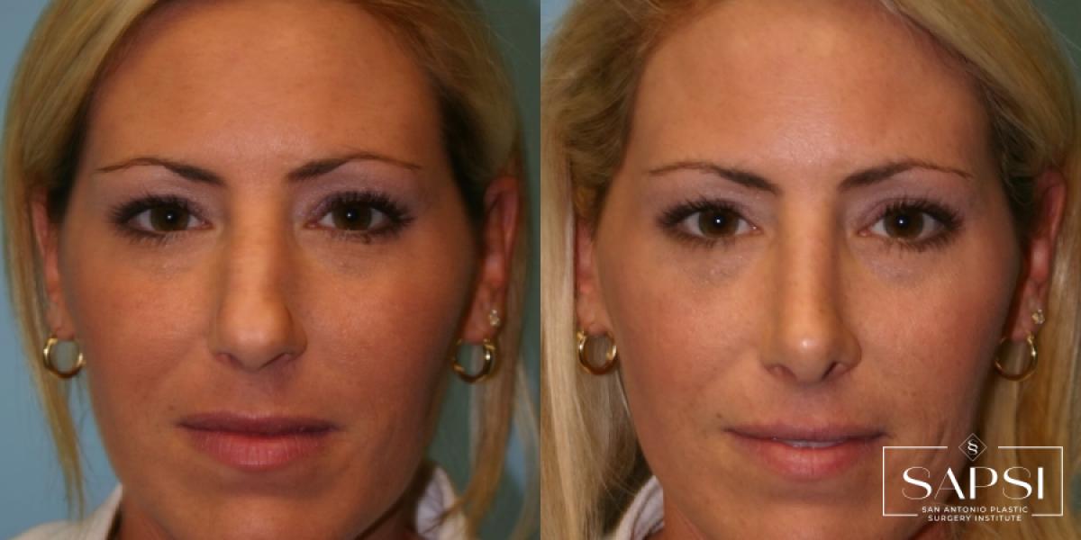 Facelift: Patient 4 - Before