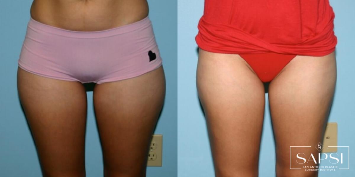 Liposuction: Patient 11 - Before and After 
