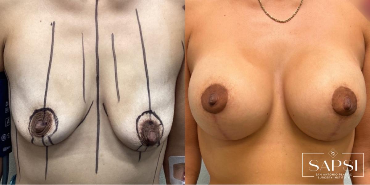 Breast Augmentation With Lift: Patient 22 - Before and After 