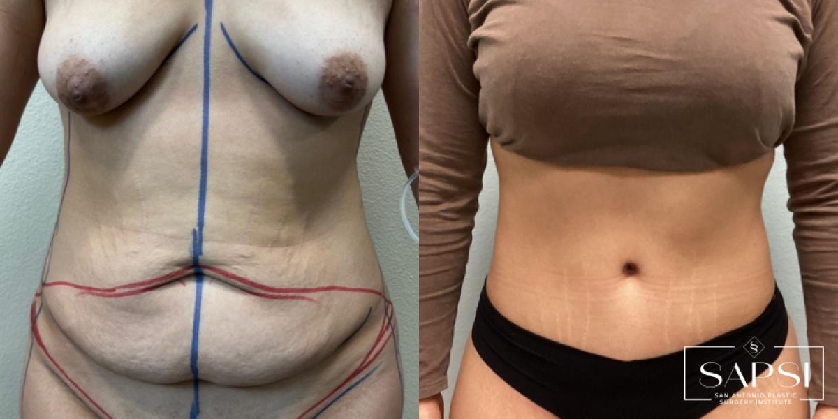 Tummy Tuck: Patient 3 - Before