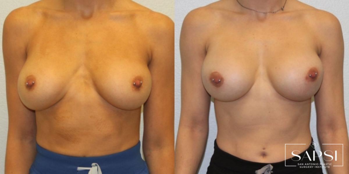 Breast Revision: Patient 1 - Before