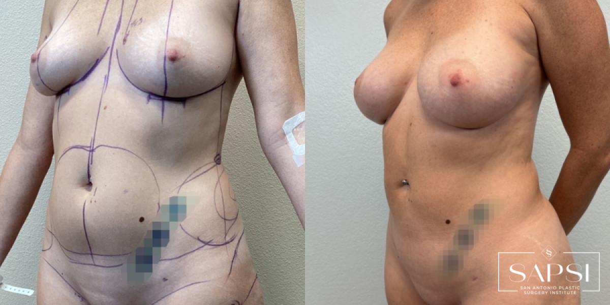 Liposuction: Patient 2 - Before