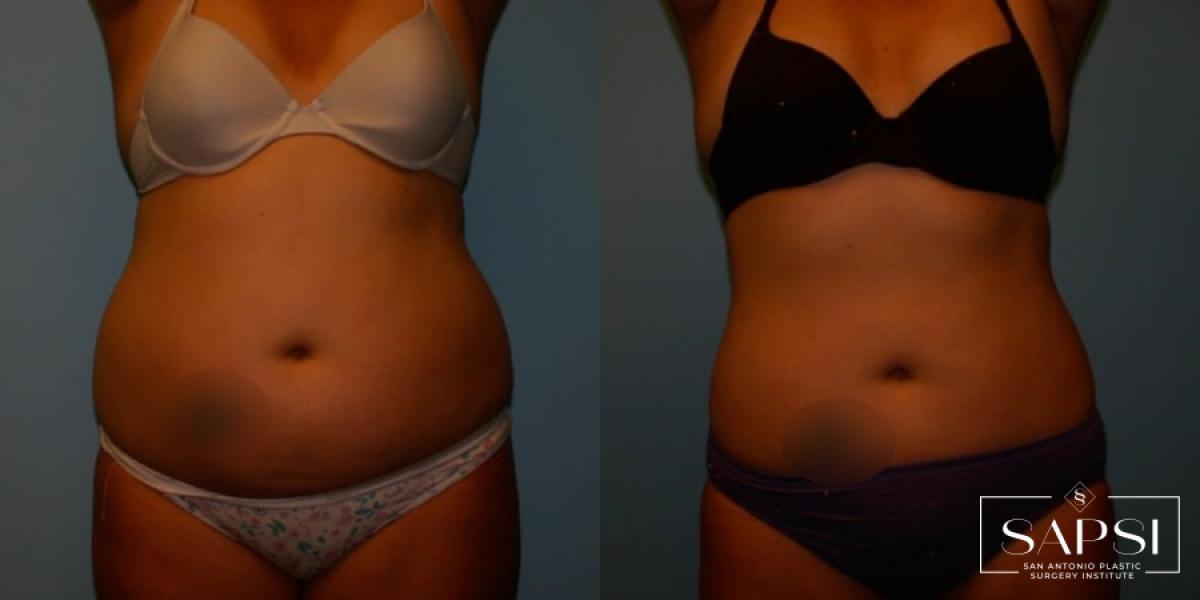 Liposuction: Patient 9 - Before