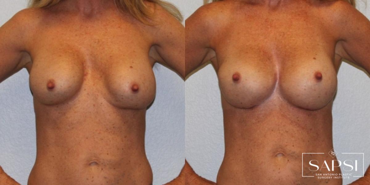 Breast Revision: Patient 7 - Before