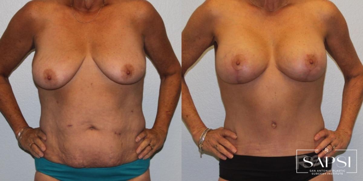 Breast Lift: Patient 8 - Before
