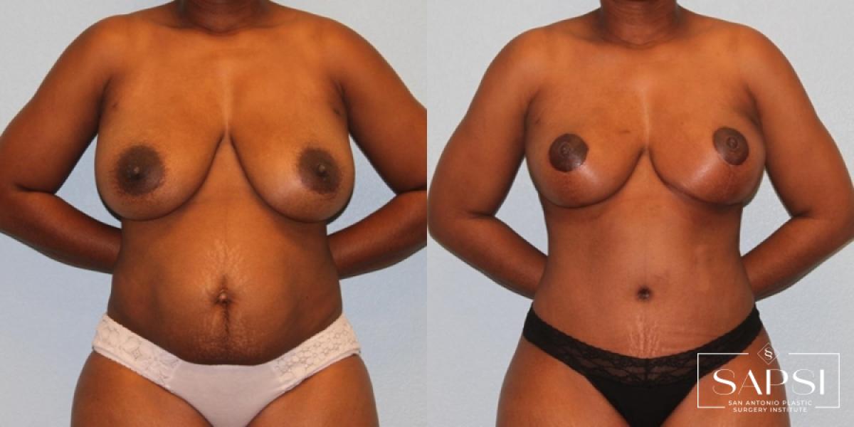 Mommy Makeover: Patient 43 - Before and After 