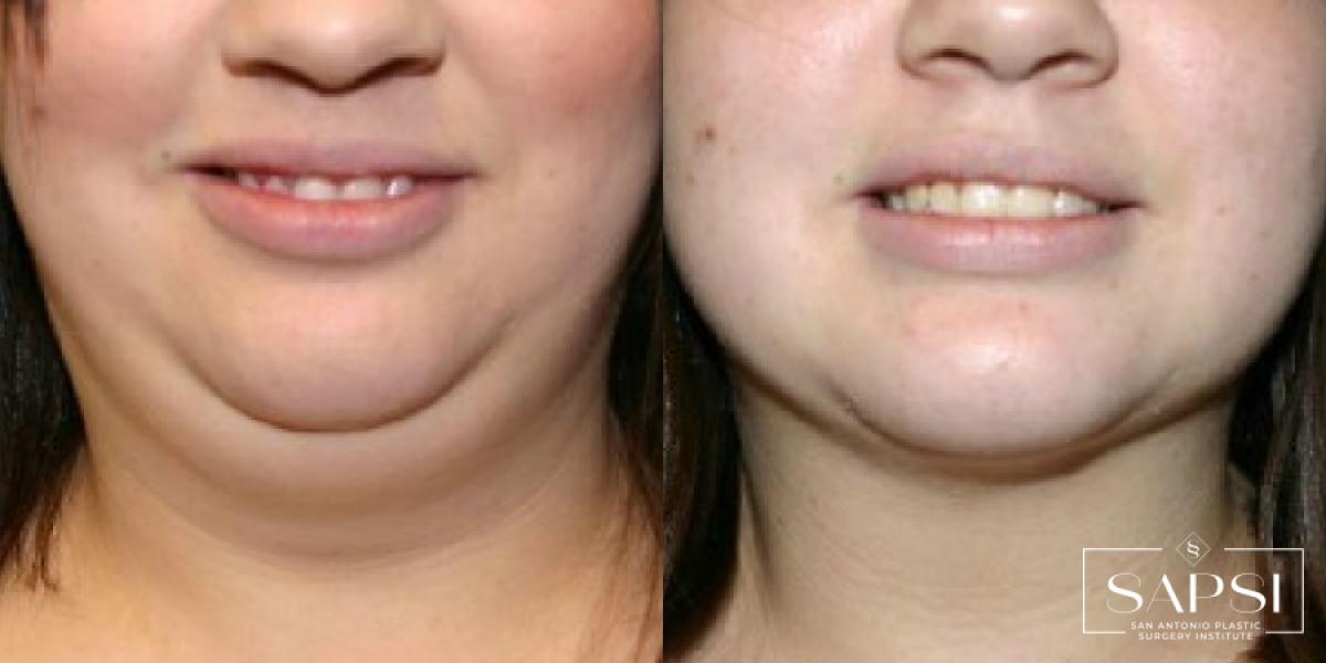 Liposuction: Patient 6 - Before