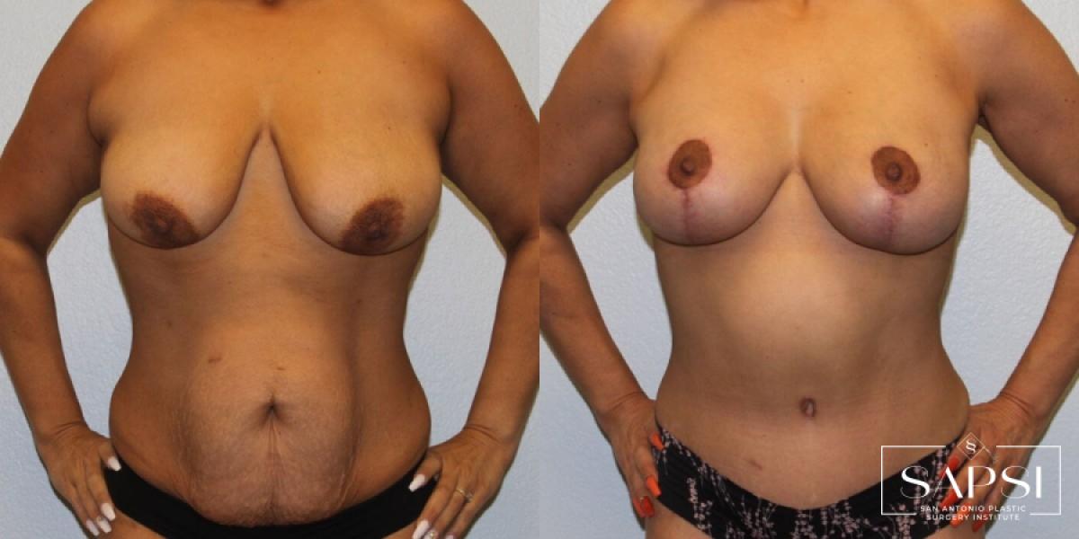 Body Contouring: Patient 8 - Before