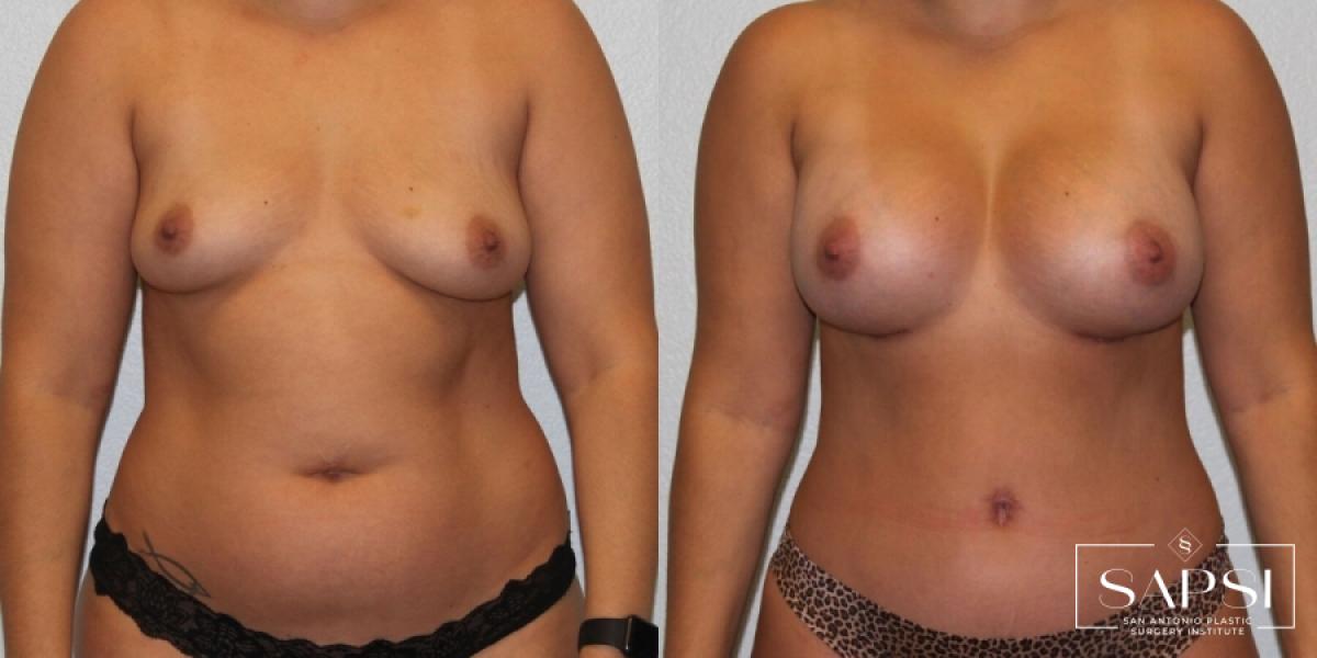Mommy Makeover: Patient 27 - Before and After 
