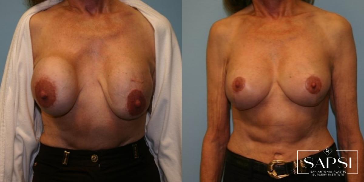 Breast Revision: Patient 9 - Before