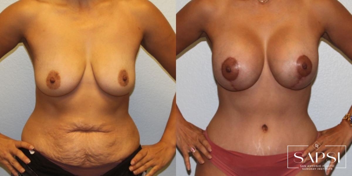 Body Contouring: Patient 9 - Before