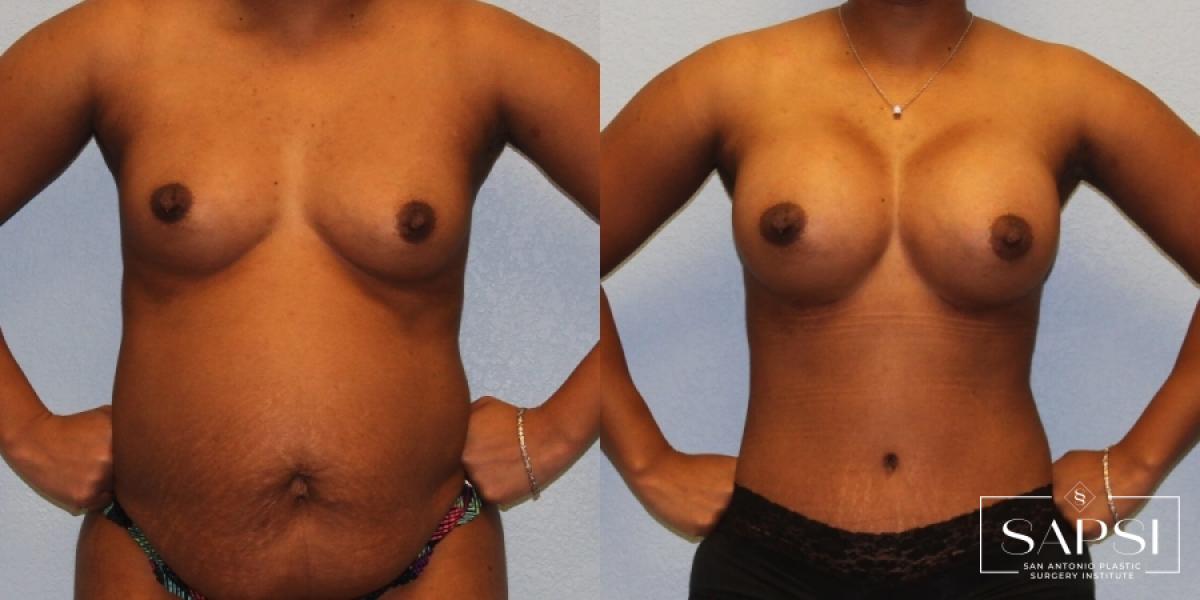 Mommy Makeover: Patient 14 - Before and After 