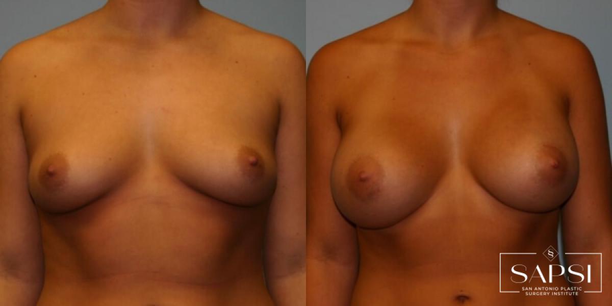 Breast Augmentation: Patient 7 - Before
