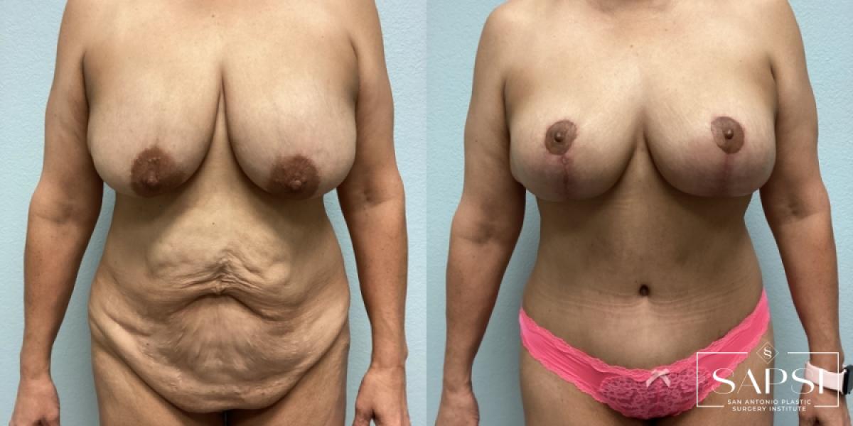 Mommy Makeover: Patient 5 - Before