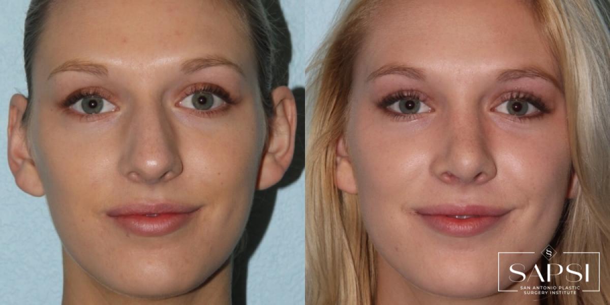 Facelift: Patient 2 - Before