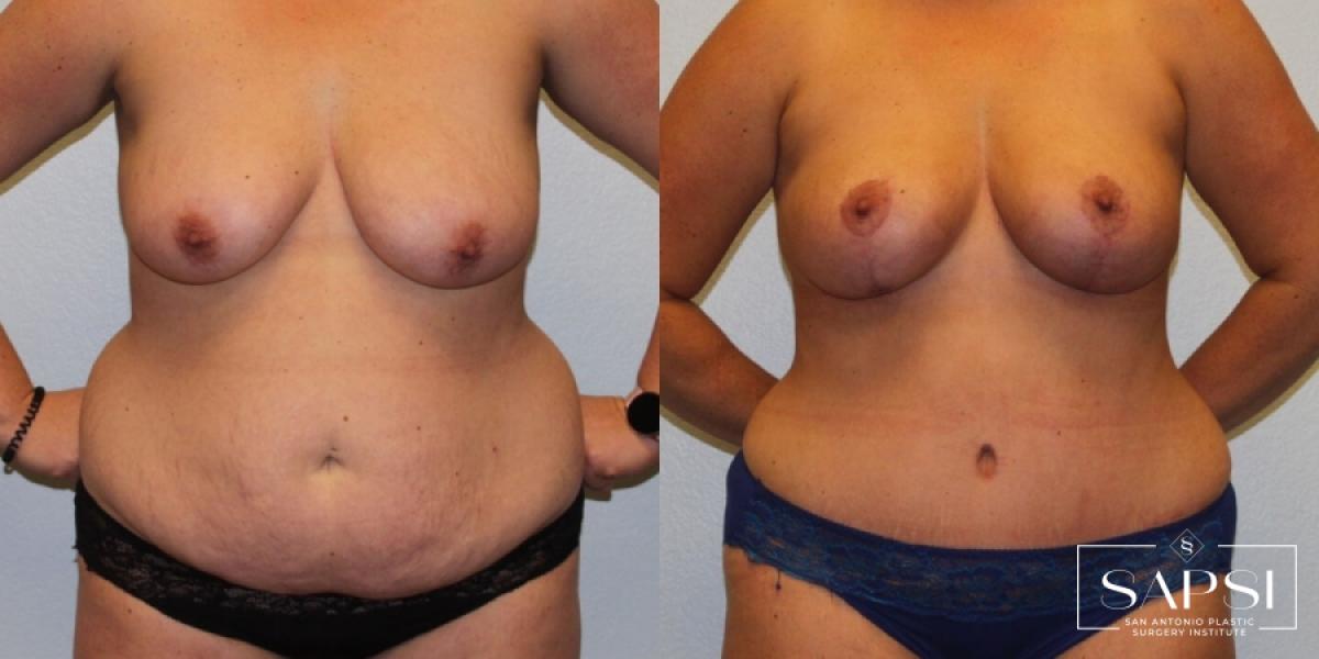 Body Contouring: Patient 5 - Before