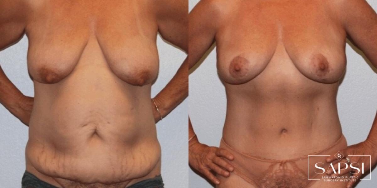Body Contouring: Patient 7 - Before