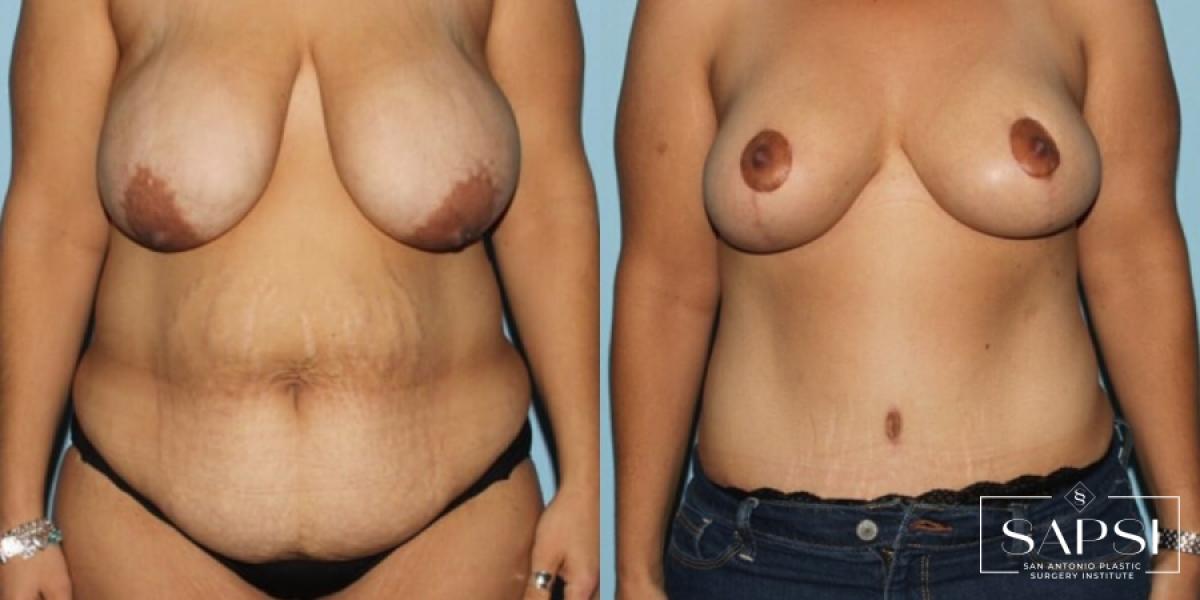 Mommy Makeover: Patient 20 - Before and After 